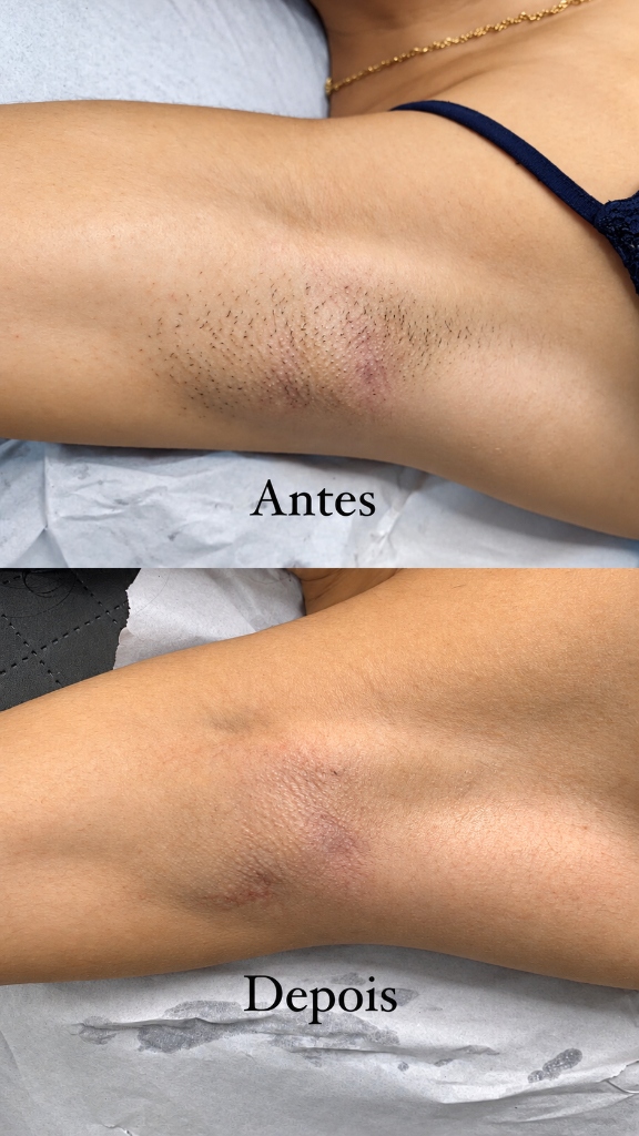 Comparativo de depilação a laser nas axilas antes e depois